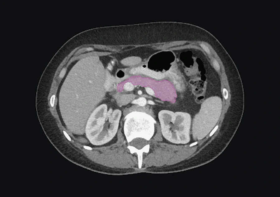 Tall axial de TC abdominal real, amb l’anotació manual del pàncrees ressaltada en violeta.